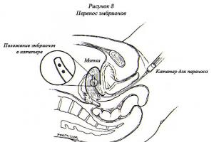 Процедура хетчинга эмбрионов