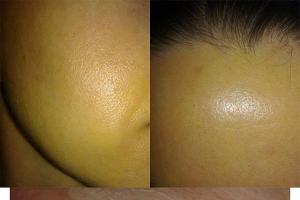 Retinoic peeling: reviews, before and after photos, contraindications and complications
